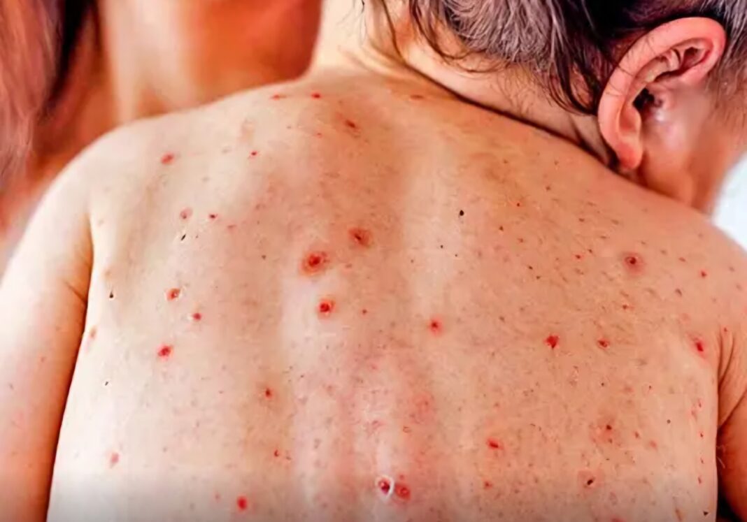 Se confirma el cuarto caso de sarampión en Nueva York, lanzan portal en línea sobre el tema