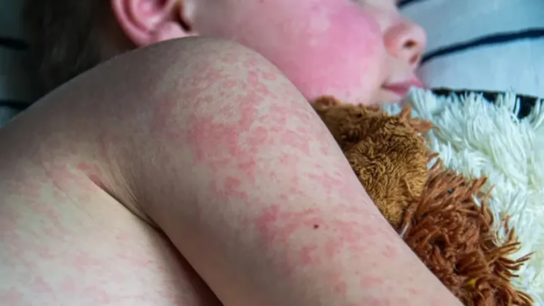 Siguen en aumento casos de sarampión; enfermedad podría volverse endémica en EE.UU.