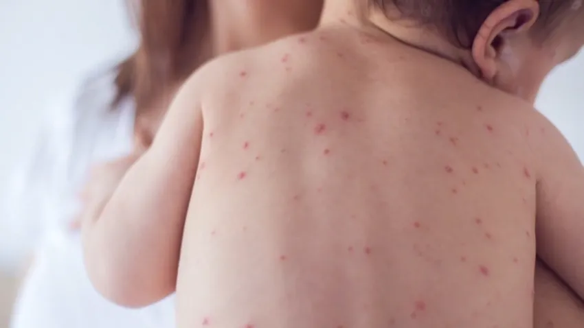 Michigan anuncia un segundo brote de sarampión y EEUU alcanza 1,227 casos