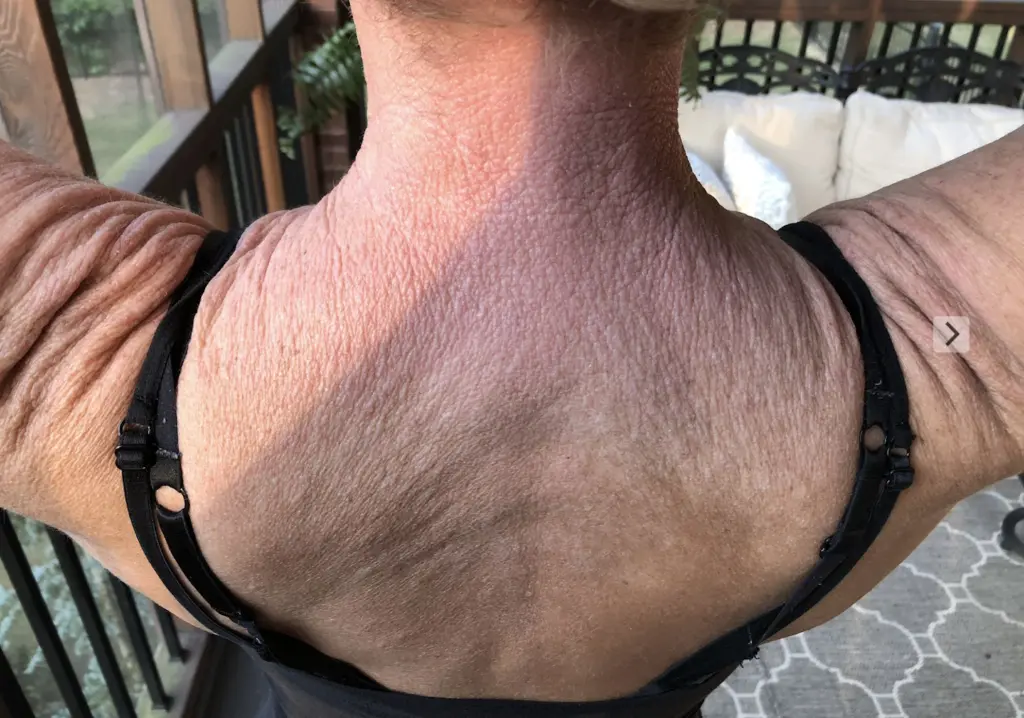 La aterradora condición que quienes la padecen dicen «te atrapa en tu propio cadáver medio vivo» es causada por un medicamento que toman millones de personas.